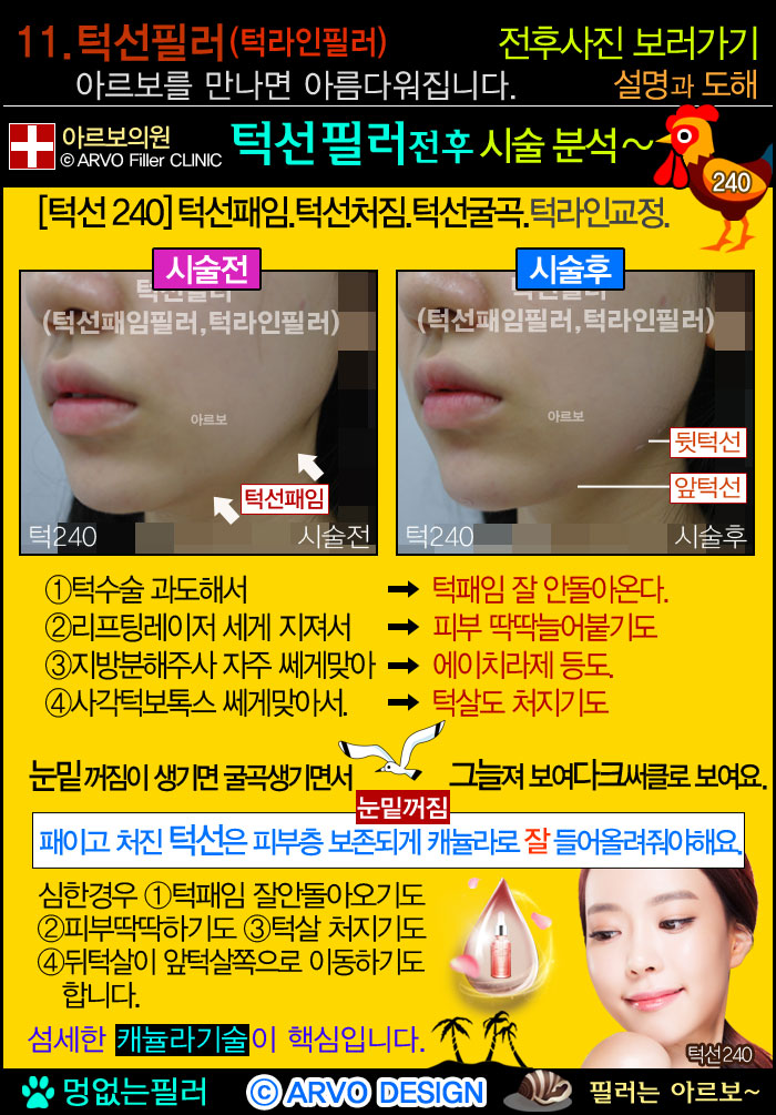 턱선필러,턱선패임필러,턱라인필러,브이라인,브이라인필러,브이라인턱,턱선필러전후설명