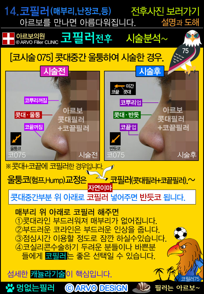 코필러,콧대필러,코끝필러,코필러전후설명,매부리코,새부리코,매부리코필러