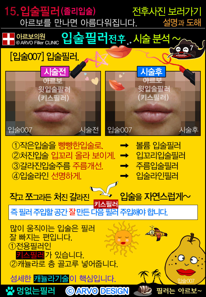 입술전용필러,입술필러,아랫입술교정정도,아래입술필러 볼륨2타입