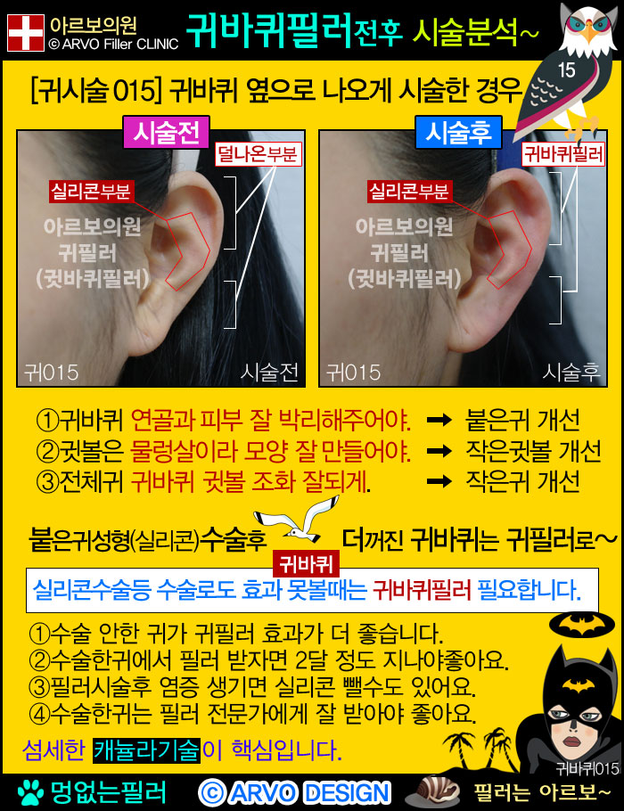 붙은귀,누운귀,실리콘귀성형,패인귀,귀패임,둥근귀귀관상,귀성형,귀바퀴필러,귀필러,귓바퀴필러,아르보의원