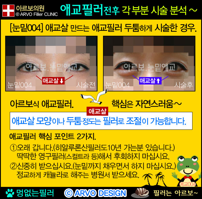 애교필러,애교살필러,눈밑필러,다크서클,다크써클,애교필러주의점2가지