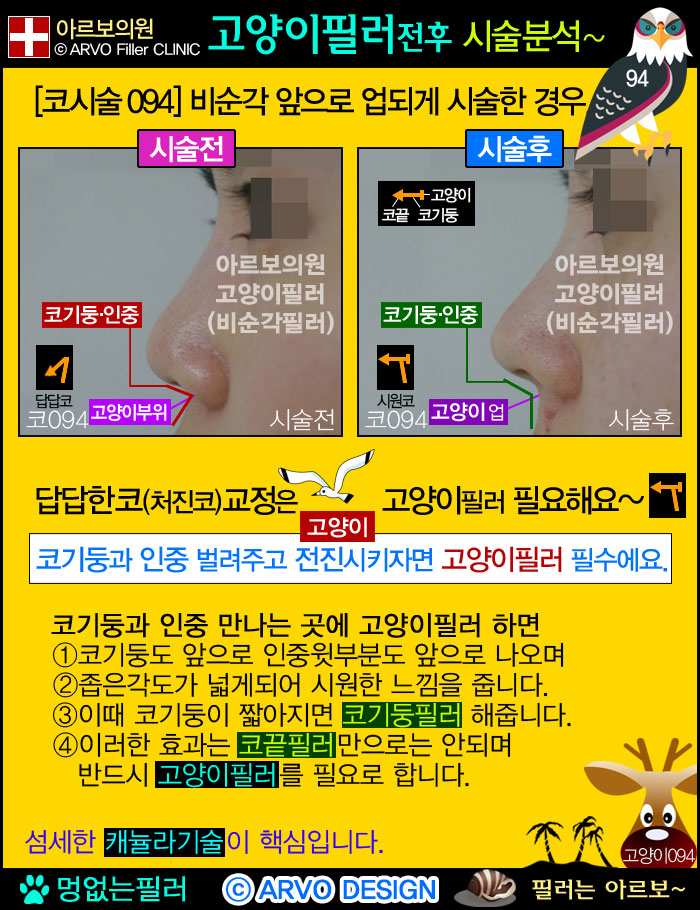 비순각필러,인중필러,고양이필러,고양이수술,고양이시술 ,고양이필러효과,코기둥,인중